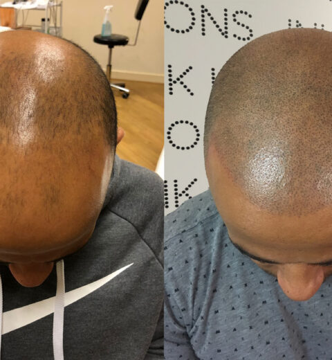 antony scalp micropigmentation london before after