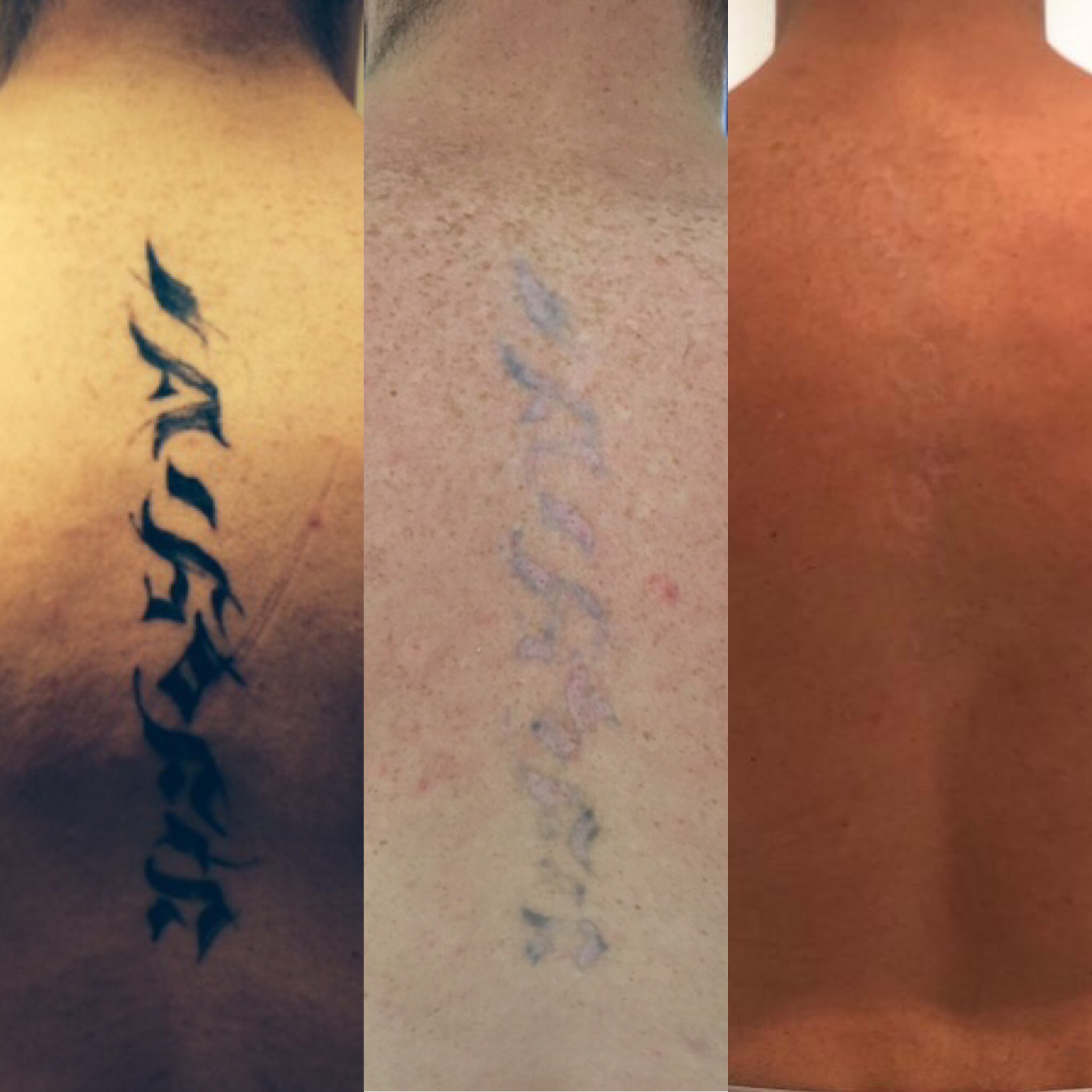 How to remove permanent tattoo without laser - Quora