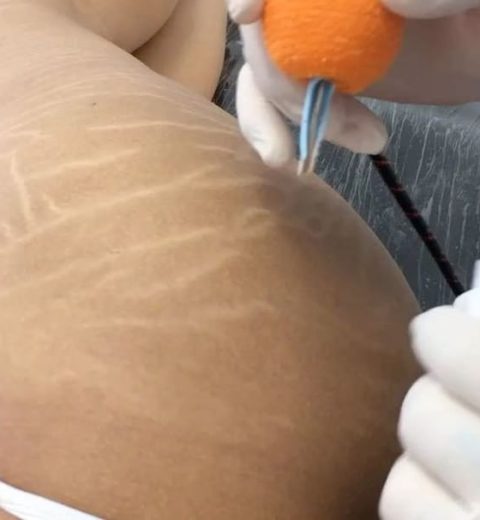 stretch marks camouflage before after