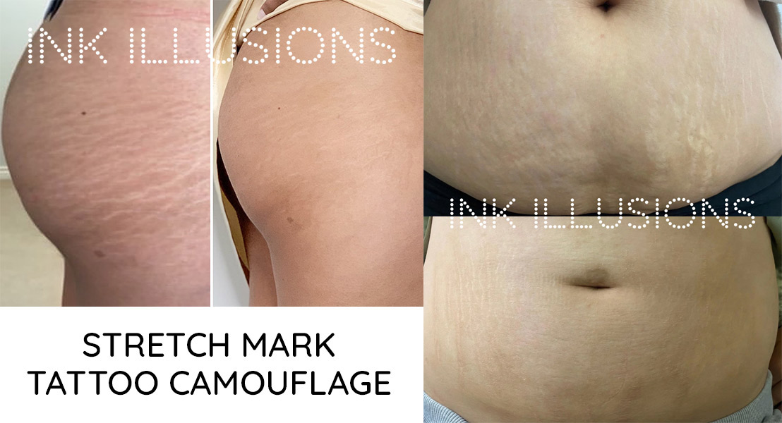 Services  Stretch Mark Camouflage Tattoo  Scar Revision AZ