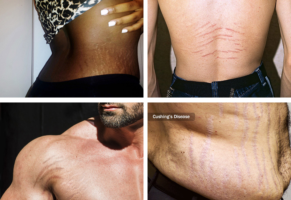 Scar Camouflage with skin coloured tattooing that lasts for years