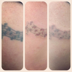 Laser Tattoo Removal in Brentwood TN and Nashville