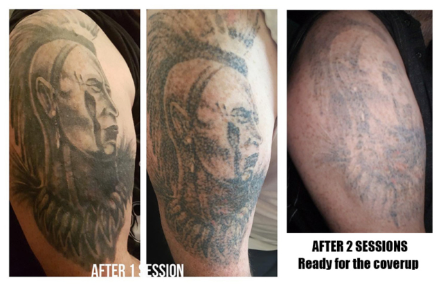 Paul after 3 sessions of laser tattoo removal in Brentwood CM15