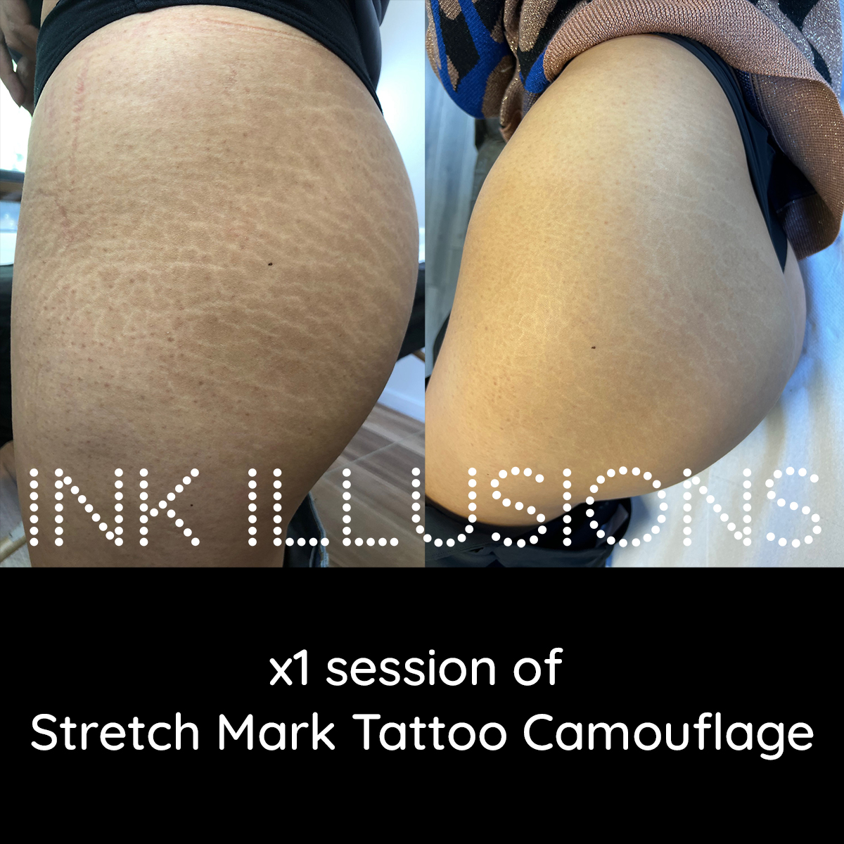 What is the most effective treatment for Stretch Marks? - Ink Illusions
